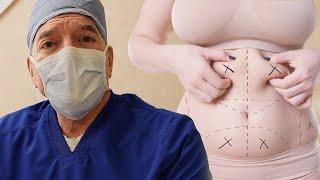 Q&A - How long is the recovery time for a tummy tuck? l Dr Kagan l  Body Aesthetic Center