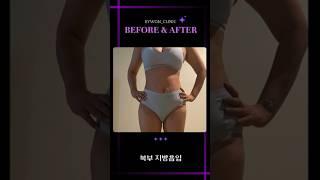 복부 지방흡입 리얼후기 #지방흡입후기