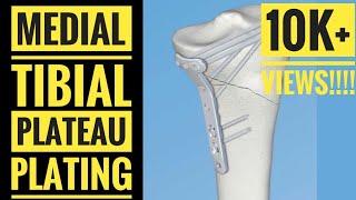 Medial Approach and Plating of Medial Tibial Condyle