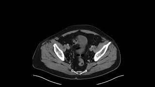 Gastric ulcer