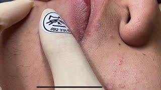 Blackheads Removal Boy 2024 | Acne Treatment With Bo Nguyễn Spa