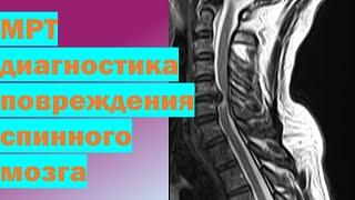 МРТ диагностика повреждения спинного мозга | МРТ при травме шейного отдела позвоночника