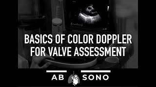 Basics of color Doppler for valve assessment