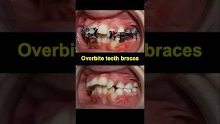 Braces time lapse. Fix Overbite teeth #braces #orthodontist #dentist #dentistry