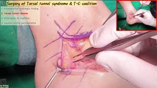 467.(의사용.Surg. 통합본 1~4) Painful talo-calcaneal coalition with Tarsal tunnel syndrome [강찬.Chan KANG]