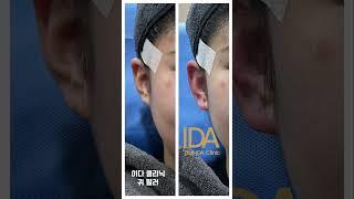연예인들이 좋아하시는 필러가 어느 부위 필러인지 아시나요?