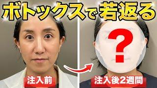 ボトックス治療での若返りの様子を大公開！【美容医療】