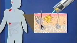 How Does a Dendritic Cell Vaccine Work?