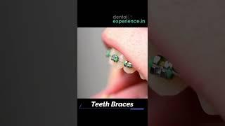 Affordable | Metal braces | Ceramic Teeth Braces | Clear Teeth Aligners Cost in Kochi, Kerala, India