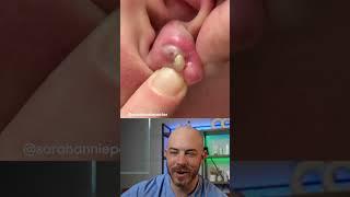 Doctor reacts to foul infected piercing pop! #earpiercing #pimplepop #infection