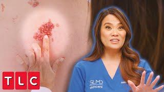 Oddly Satisfying Back Bumps? Dr. Lee Adores This Strange Patch of Bumps | Dr. Pimple Popper