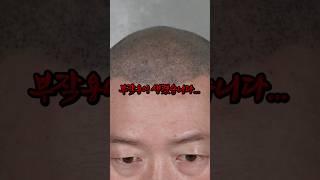 두피문신 부작용 조심하세요