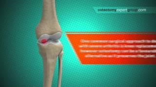 Osteotomy Animation i