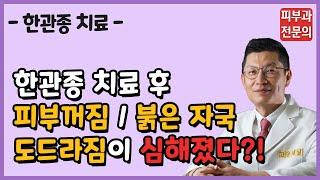 한관종 치료 후 꺼짐, 붉은 자국, 흉터, 도드라짐은?