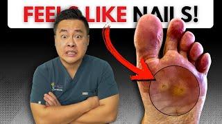 Painful “Nail” in His Foot? Shocking Porokeratoma Removal!