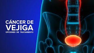 Cáncer de Vejiga - Una experta explica opciones de tratamiento