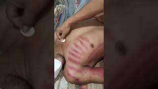 @thanhLiêmNguyễn-u4i5p , cạo gió anh bạn an(giò dài) cảm lạnh ho
