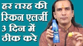 स्किन एलर्जी का घरेलू नुस्खा How To Cure Skin Allergy - skin allergy treatment at home -Sachin Goyal