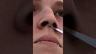 Ever Wonder How Rhinoplasty Surgery Works!|Nose job done