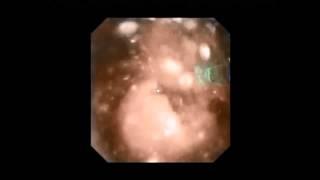 Kidney Stone Treatment by RIRS with flexible ureterorenoscope