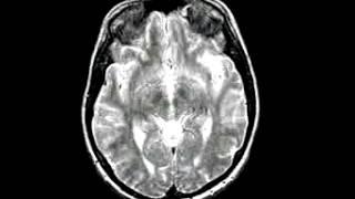Cerebrovascular Disease Acute stroke Carotid
