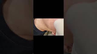 송곳형 아이스픽 흉터는 모공으로 오인하기 쉽습니다. 레이저보다는 도트필 화학적 치료가 효과적입니다