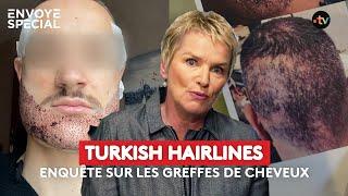 Turkish hairlines, enquête sur la greffe de cheveux - extrait