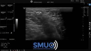 Lateral Femoral Cutaneous Nerve