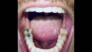 Dental Exam, Male Teeth, Male Mouth, Dentist, Teeth Fillings, Silver Fillings,Amalgam Fillings