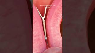 IUD Removal #shortvideo #viral