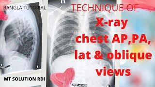 X ray chest ap,pa,lat &oblique (Ep-14) |Technique of chest x-ray |procedure of chest|bangla tutorial