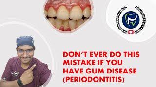 Dr Rudra Mohan |DONT EVER DO THIS MISTAKE IF YOU HAVE GUM DISEASE !| WATCH UNTIL THE END|BE CAREFUL!