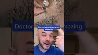 Doctor reacts to UNREAL extraction! #hair #dermreacts #doctorreacts