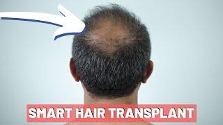 Hair Loss News 2019 - Smart Hair Transplant Update