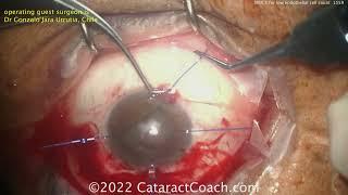 CataractCoach 1559: MSICS for patients with low corneal endothelial cell counts (ECC)