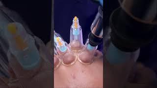 #doublechin #doublechinremoval #chennai #bangalore #bengaluru #viral #viralvideo #shorts #shots