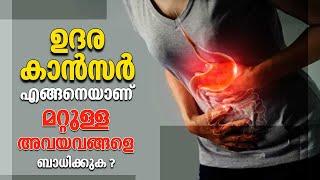 Stomach cancer | ഉദര കാൻസർ എങ്ങനെയാണ് മറ്റുള്ള അവയവങ്ങളെ ബാധിക്കുക ? | Arogya Kaumudy