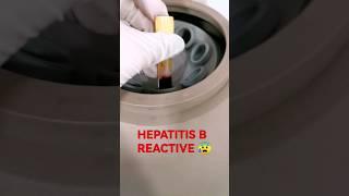 Reactive Hepatitis B Testing #laboratory #mls #cls #medtechstudent #medtech #hepatitisb #serology