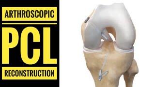 Arthroscopic PCL (Posterior Cruciate Ligament)Reconstruction with Hamstring Graft