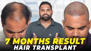 Hair Transplant in Surat | Best Results & Cost of Hair Transplant in Surat