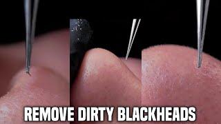 ASMR,Remove dirty blackheads, use oil compress method to maintain skin, and easily get smooth skin!