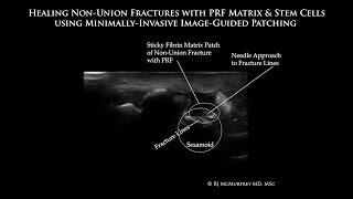 Healing Non-Union Sesamoid Fractures with PRF Fibrin Matrix (Platelet-Rich Fibrin) & Stem Cells