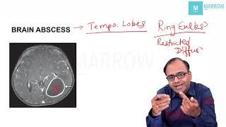 CNS - RESTRICTED DIFFUSION ON MRI & BRAIN ABSCESS