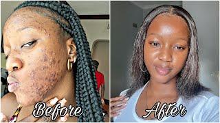 How I finally cleared my acne prone skin + Skin care routine*with photo evidence*