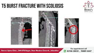 Spine Surgeries Can Be Life-Changing Success Story 2 | Dr Sahil Batra | Unstable Burst Fracture