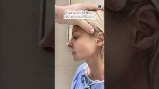 Natural Results| Facelift 4 Months Post-Op| Before and After