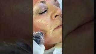 Collagen pin - Skin Perfection London