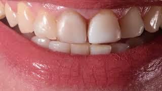 Veneers Composite Vs  Porcelain Veneers - Dr Walid Zalaket Beirut Lebanon