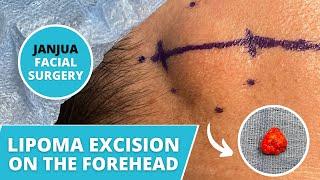 LIPOMA EXCISION ON THE FOREHEAD - DR. TANVEER JANJUA - NEW JERSEY