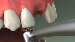 Dentist - Maryland Bridge Procedure